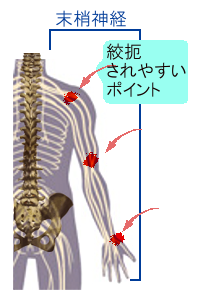 上肢の末梢神経障害が起こりやすいポイントをイメージしたイラスト